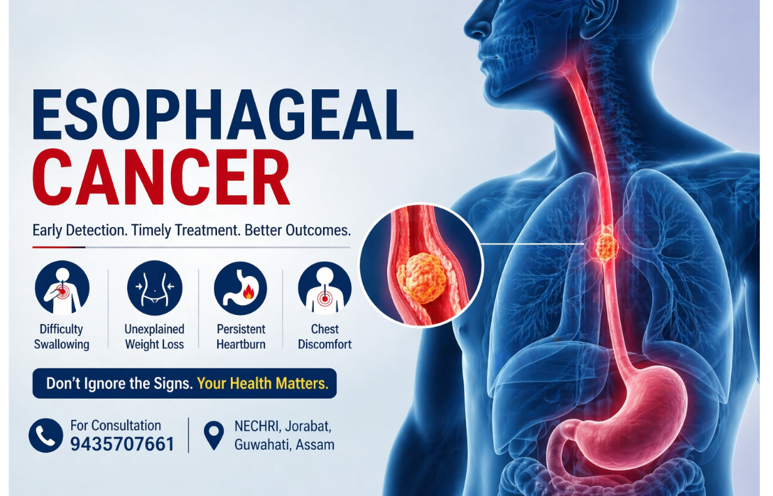 Esophageal Cancer: Early Signs, Risk Factors & Treatment in Guwahati